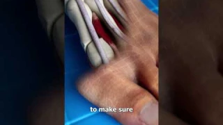 Bunion Correction 😨 (explained)