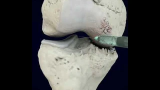 The best treatment for Knee Arthritis