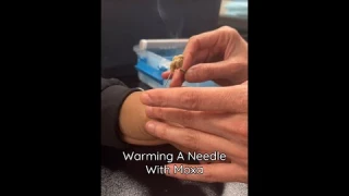 What Is Moxibustion?​
