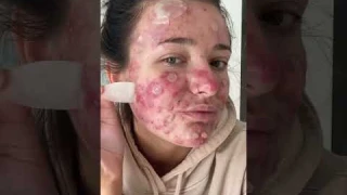 Best Fazit’s Pimple Patch Peels! #acneproneskin #acne #acnepositivity #pimplepopper #pimplepatch