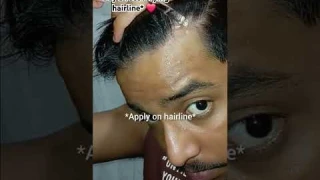 🤞🤞DAY5of using Bare anatomy hair growth serum until recoverying hairline #aidhair #shorts #haircare