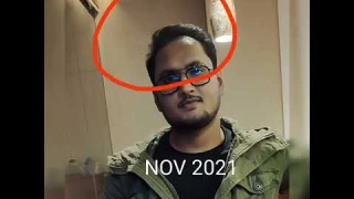 11 months hair transformation with traya's hair treatment