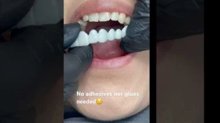 No other cosmetic appliance does this ! Snap-on Smile ❤️