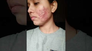 tretinoin cream review 1 for dark spots, acne, pimple, pimple marks, pigmentation, acne marks