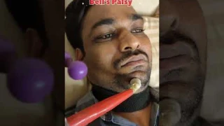 Bell's Palsy Muscle Stimulation #shorts #bellspalsy #facialparalysis