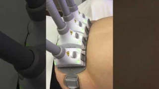 Fat Reduction without Surgery? It's Possible with SculpSure! #sculpsure #fatloss #viral