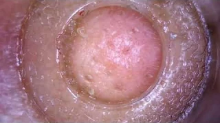 Customer Reviews Blackhead Remover, Pore Vacuum Cleanser with HD Camera