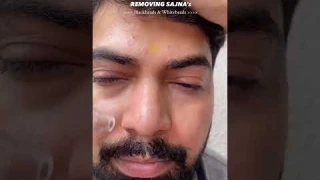 Blackhead Remover | Winston Blackhead Remover