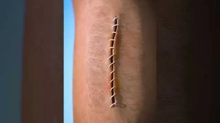 How Stitches Work 😯