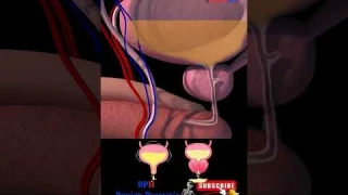 BPH - Benign prostatic enlargement - 3D Animation - Urine Retention