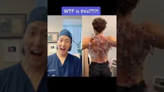 Extreme Cupping Therapy! #shorts #cupping