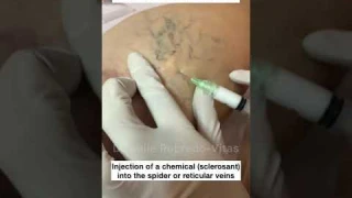 Sclerotherapy for Spider and Varicose Veins #Shorts