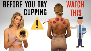 Doctor SHOCKED by Robo Cupping Therapy Device! Is AchedAway Safe for At-Home Use?
