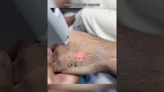 dont do this ipl laser hair removal