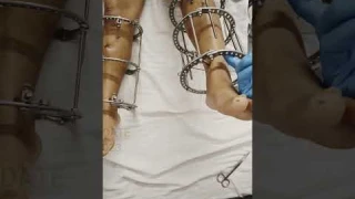 Height Increase Surgery | Surgery For Height | Limb Lengthening Surgery In Delhi