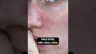 Vitamin B12 Deficiency: Symptoms, Causes, and Solutions! | Dr. Sarin |