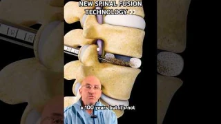High-Tech Spinal Fusion for Back Pain Relief⁉️ #shorts