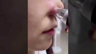 BLACKHEAD REMOVER VACUUM SUCTION FACIAL PORE CLEANER DERMABRASION FACE FACIAL PORE CLEANER DEVICE.
