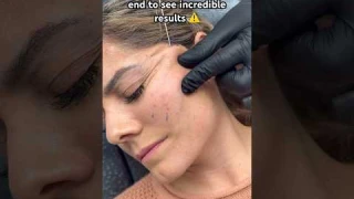 ‼️ TW ‼️ Would you try a thread lift? 👀 Results at the end! #threadlift #threads #beauty