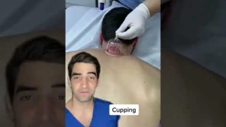 Cupping, does it work?