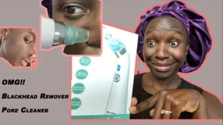 The Best Vacuum Pore Cleaner & Blackhead Remover: How to use & Review
