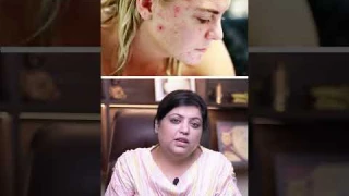 Pore Vacuums: Are they worth the hype? #skincare #shorts