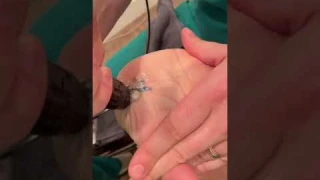 Carpal Tunnel Treatment for PERMANENT Relief Without Surgery