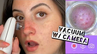 VACUUM BLACKHEAD REMOVER W/ HD CAMERA ON SENSITIVE SKIN