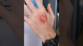 SPIDER BITES BOY! #shorts