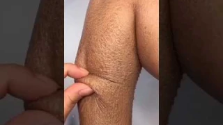 No More Dry Skin Naturally ✅ | Best Home Remedy 😱 #shorts #skincare